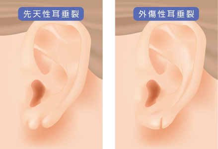 耳や、耳たぶ（耳垂）の形でお悩みの方|福岡ブリスクリニック