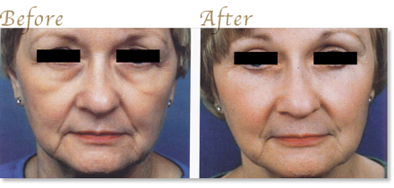 Upper and lower eyelid lifts