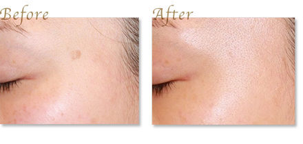 Mole and age spot removal